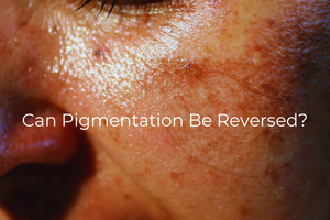 Can Pigmentation Be Reversed?