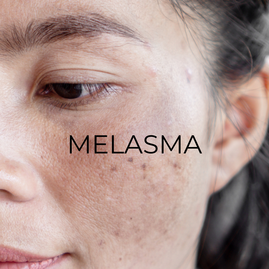 Melasma: where does the condition come from, and what you can do about to reduce it