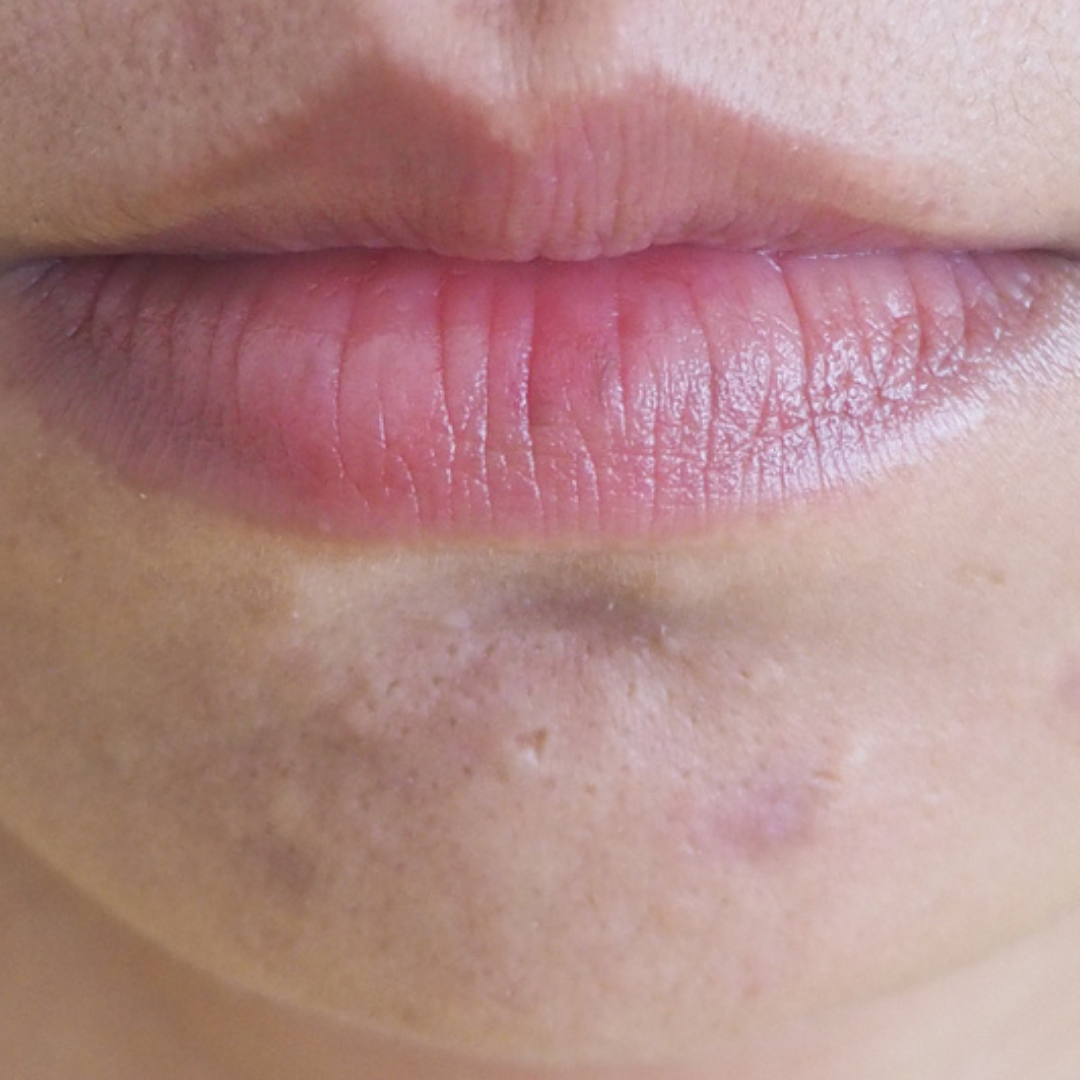 Target scars and even them out with skincare products or professional skin devices