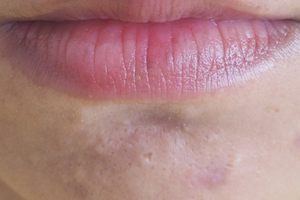 Target scars and even them out with skincare products or professional skin devices