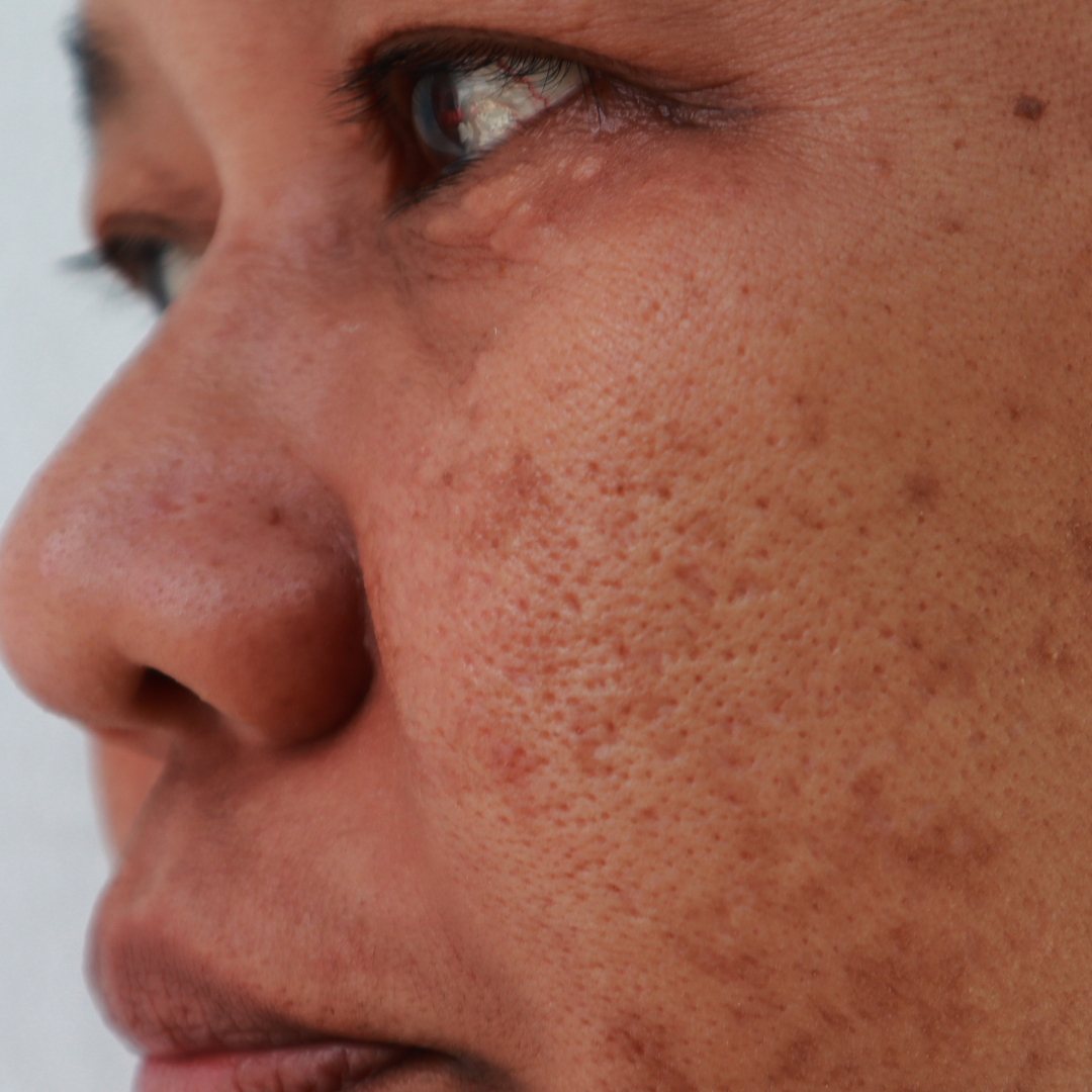 Asian skin - hyperpigmentation solutions