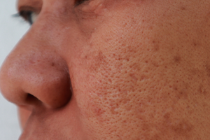 Asian skin - hyperpigmentation solutions