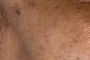 Olive skin tones and over 40? Typical pigmentation concerns and solutions