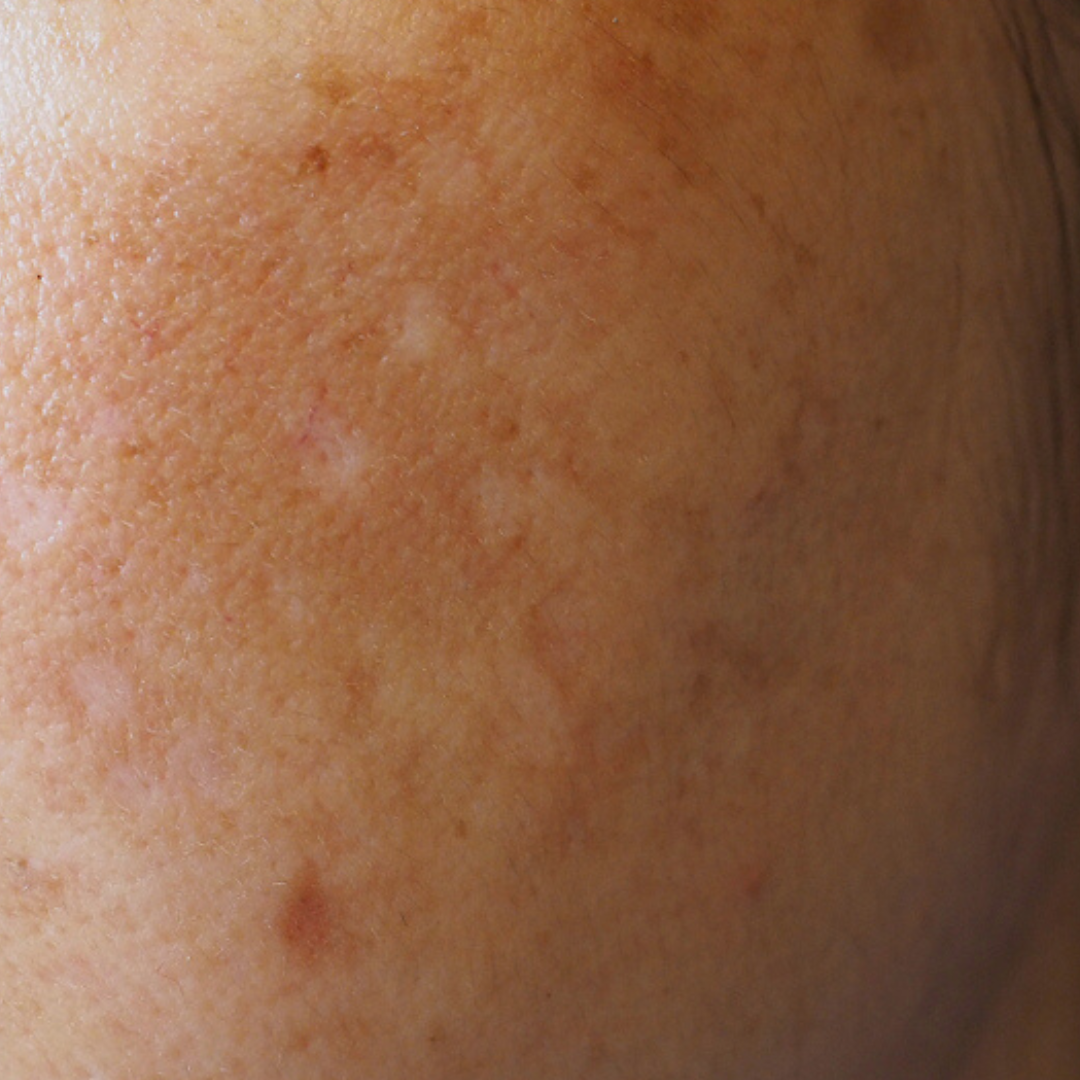 Treatments options if you have a melasma
