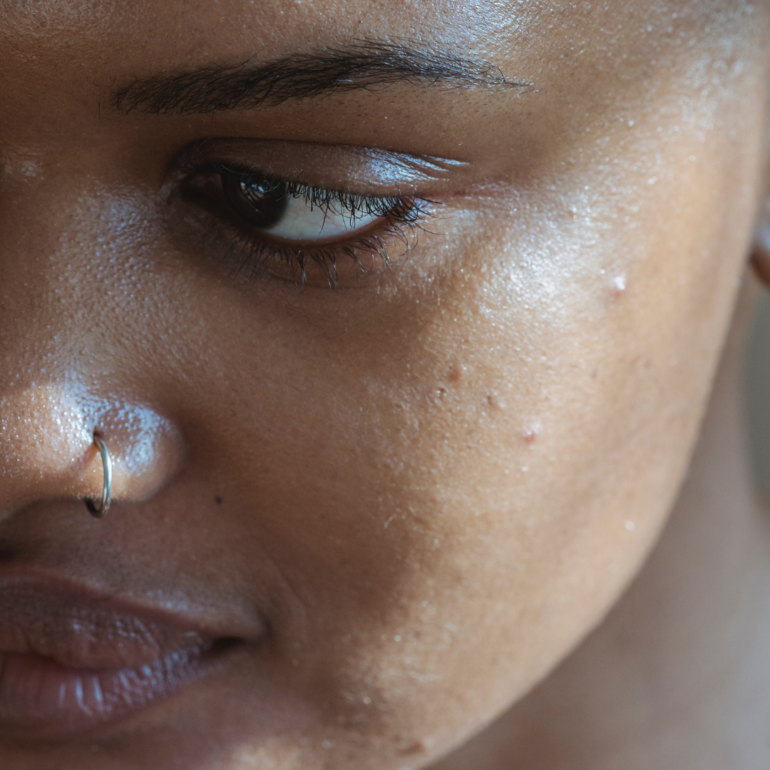 Top causes of hyperpigmentation for people with dark skin tone