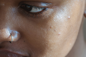 Top causes of hyperpigmentation for people with dark skin tone