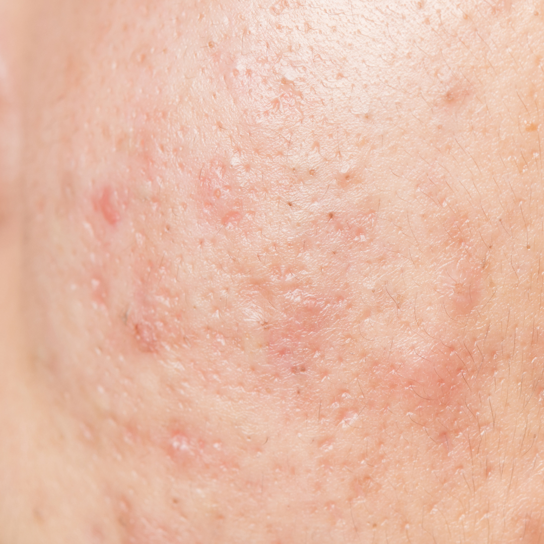 Acne scars from teenage years that won’t go away? Your options
