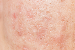 Acne scars from teenage years that won’t go away? Your options