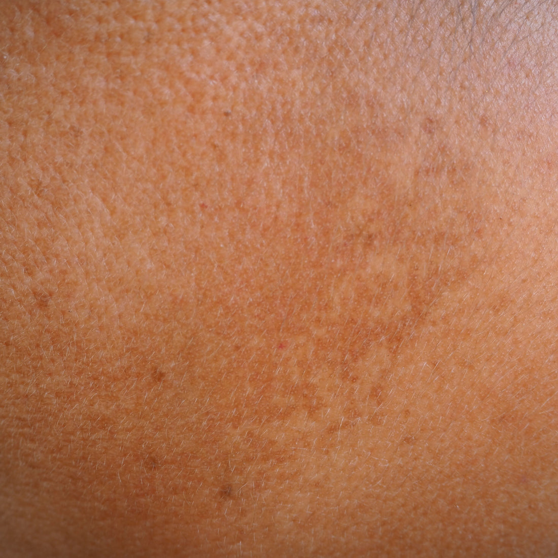Melasma, pregnancy and darker skin tones - what should you do?