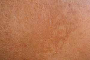 Melasma, pregnancy and darker skin tones - what should you do?