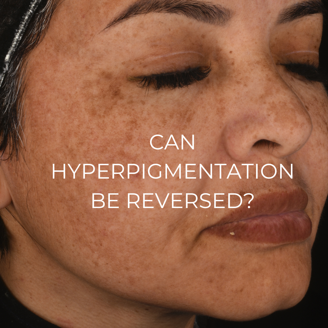Can hyperpigmentation be reversed?