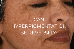 Can hyperpigmentation be reversed?
