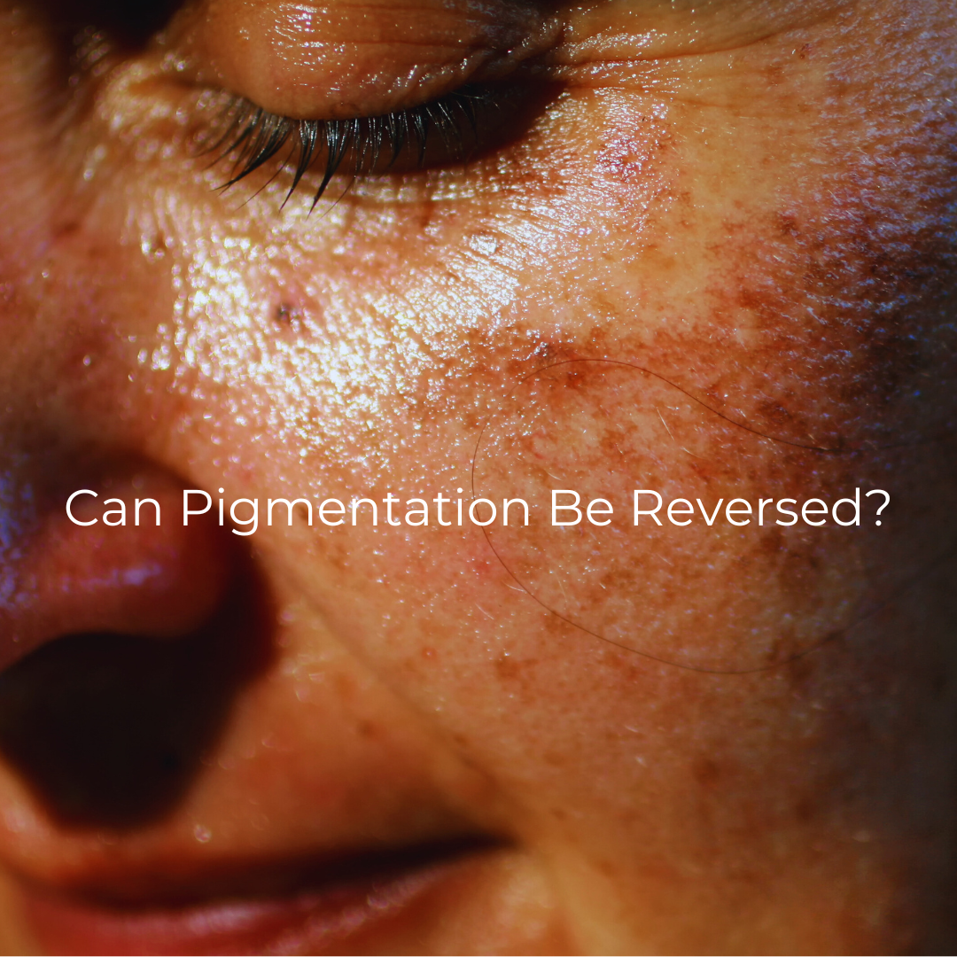 Can Pigmentation Be Reversed?