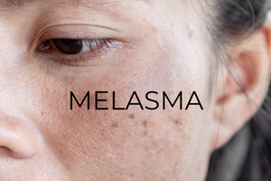 Melasma: where does the condition come from, and what you can do about to reduce it