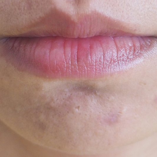 Target scars and even them out with skincare products or professional skin devices