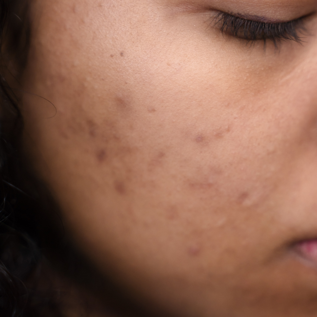 Benefits of azelaic acid for hyperpigmentation and acne scars