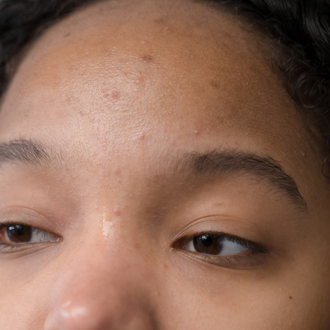 Ingredients to reduce acne scars for dark skin tones