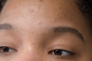 Ingredients to reduce acne scars for dark skin tones