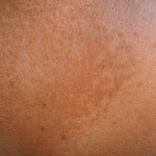 Melasma, pregnancy and darker skin tones - what should you do?
