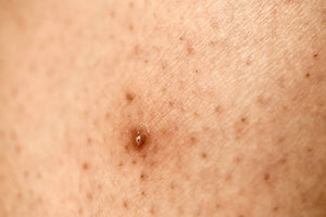 Ingrown hair - what should you do to prevent them so they don't trigger excess pigmentation?