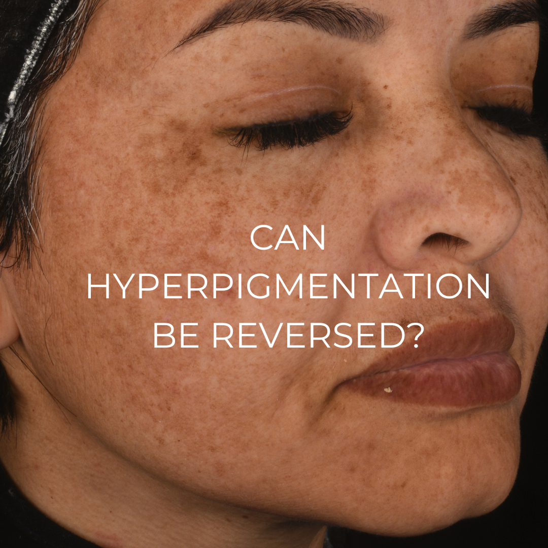 Can hyperpigmentation be reversed? – Mr. Lulu Skincare