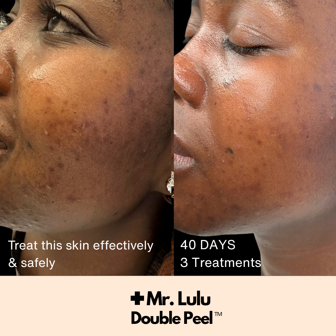 Double Peel - CERTIFICATION (COMING SOON August 31)