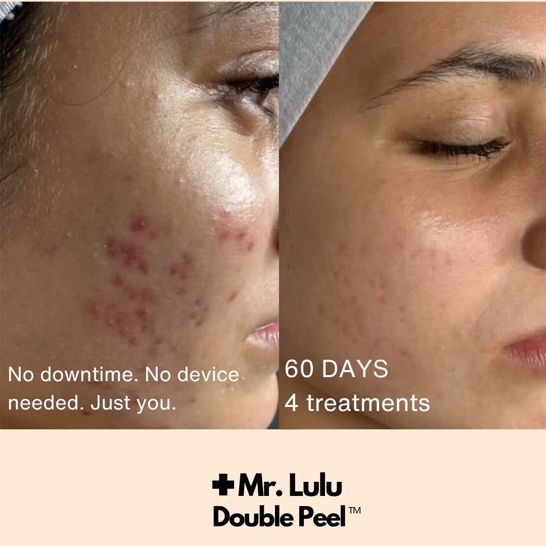 Double Peel - CERTIFICATION (COMING SOON August 31)