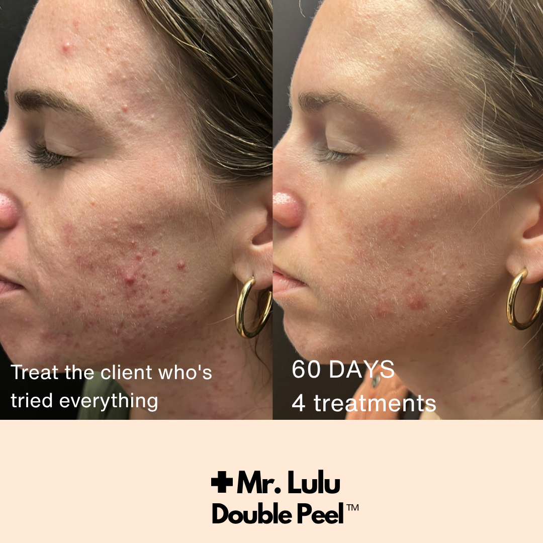 Double Peel - CERTIFICATION (COMING SOON August 31)