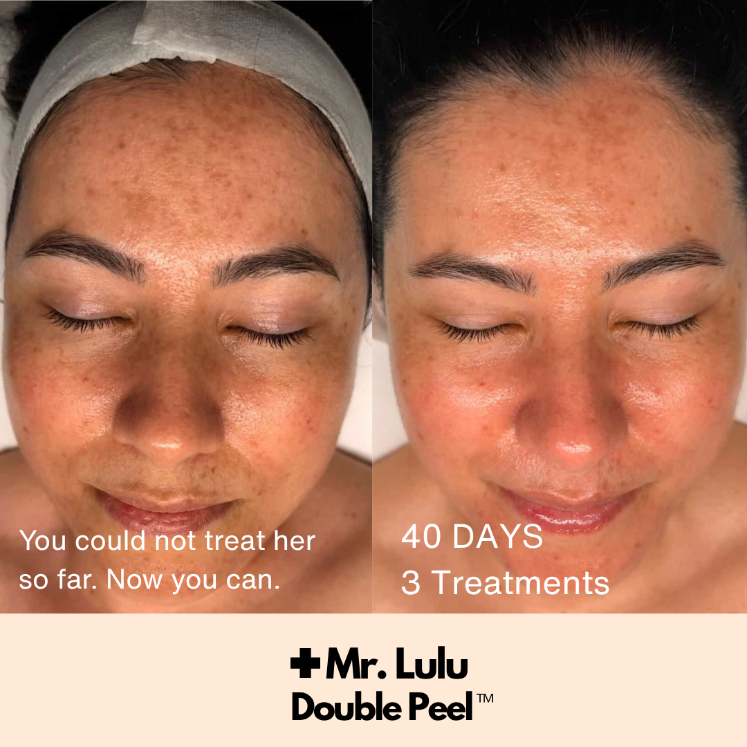 Double Peel - CERTIFICATION (COMING SOON August 31)