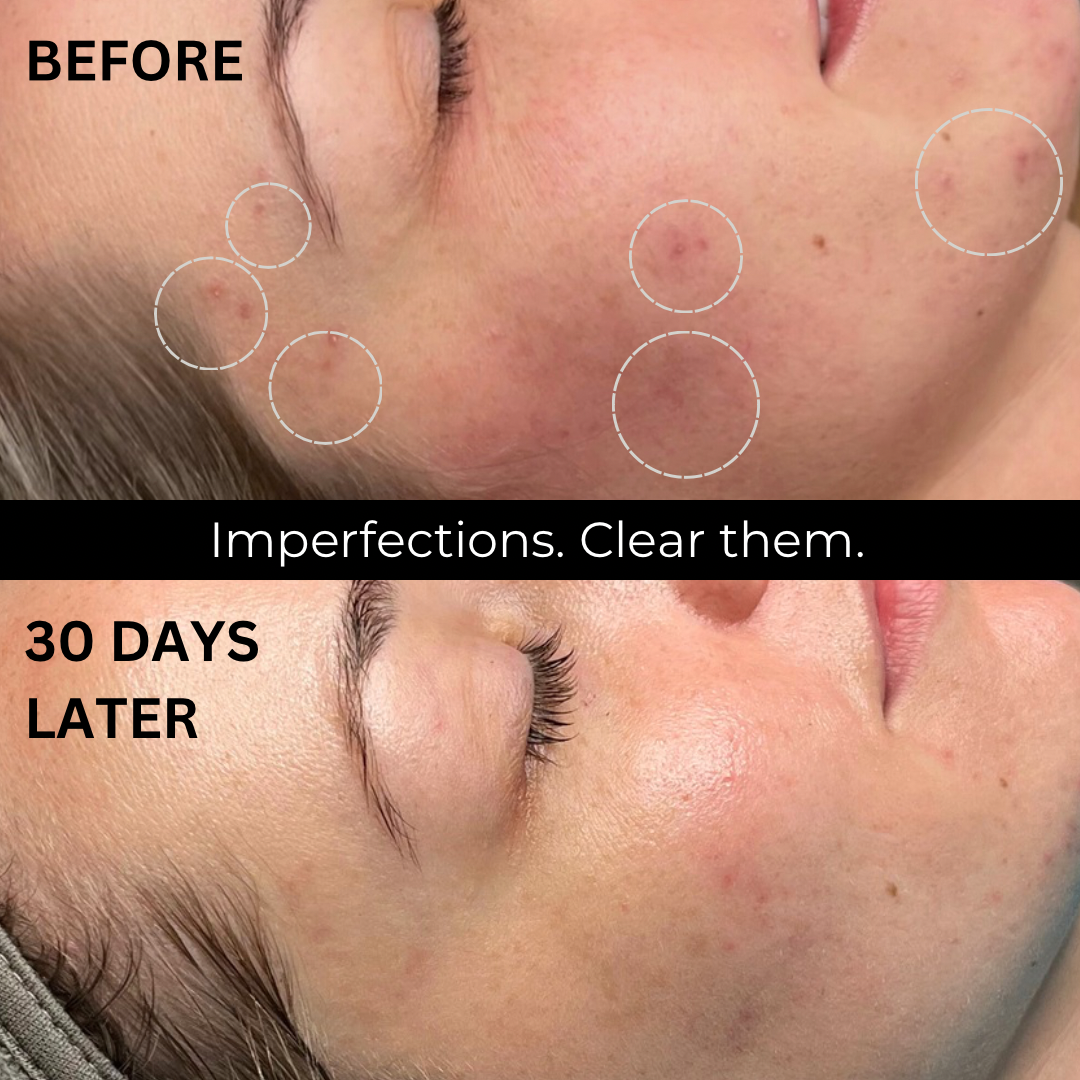 Suero en polvo azelaico retiniano