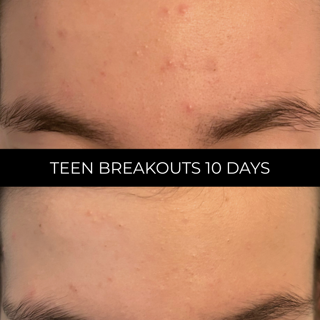 Suero en polvo azelaico retiniano