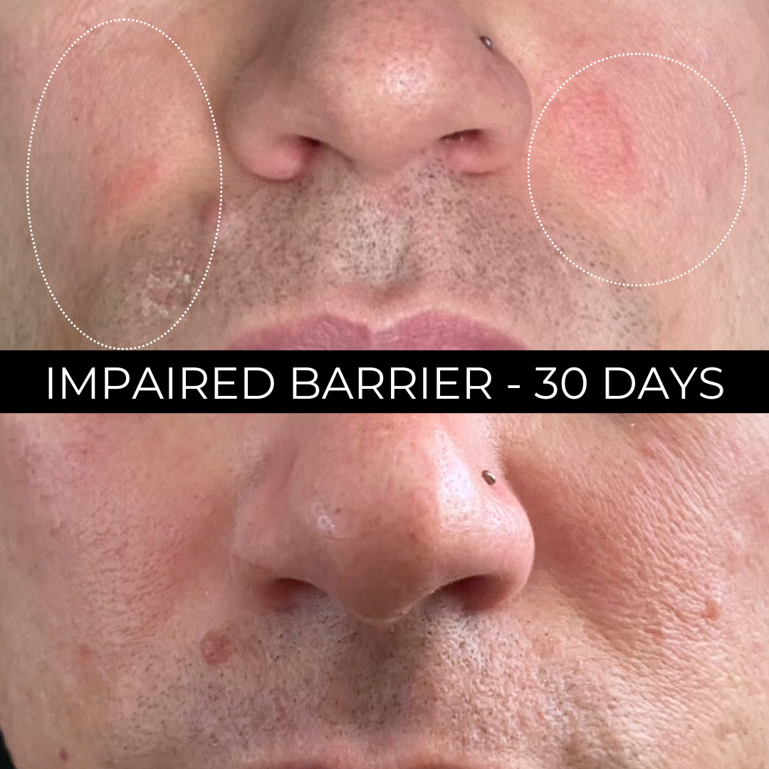 Suero en polvo azelaico retiniano